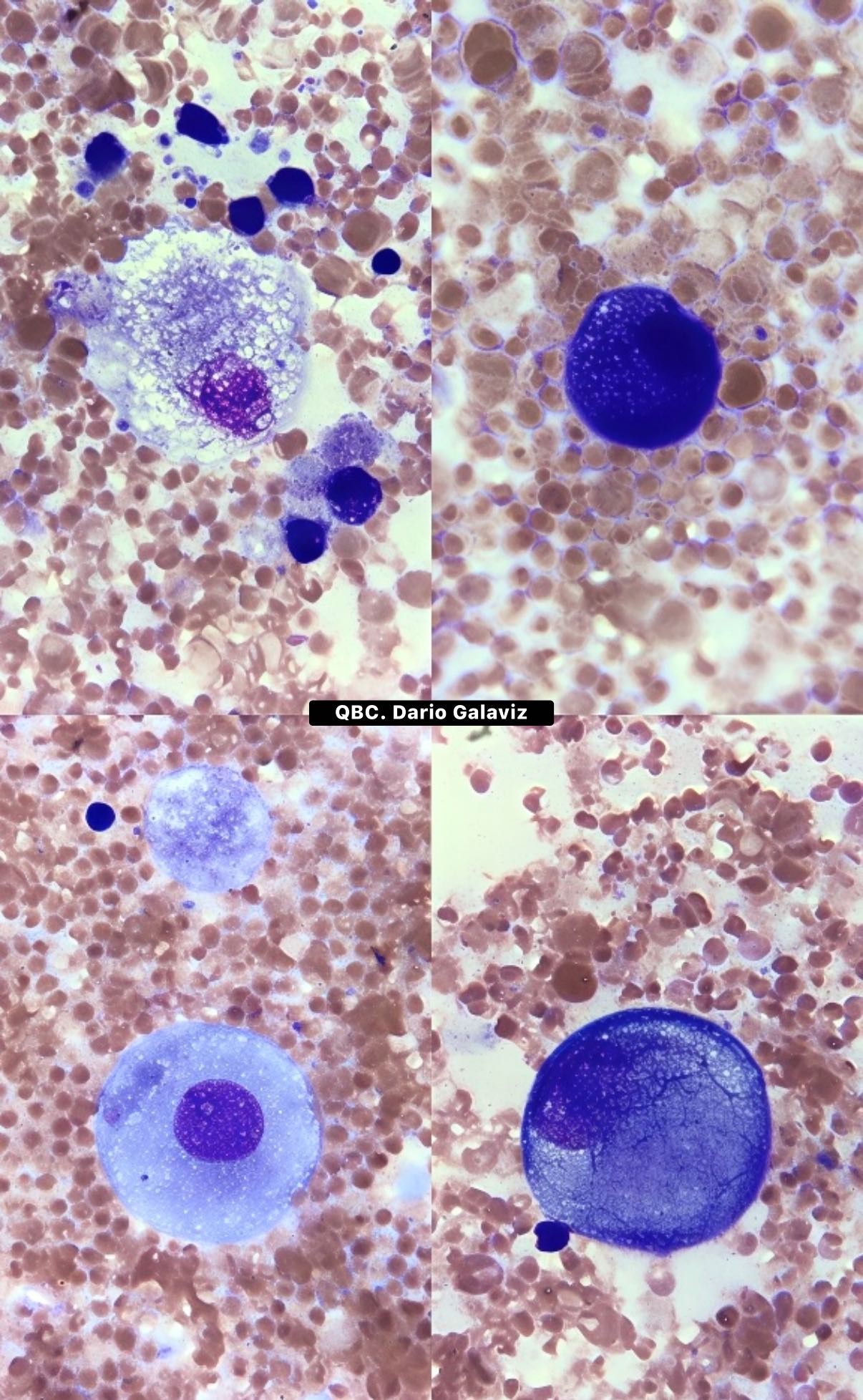 LIQUIDO PLEURAL