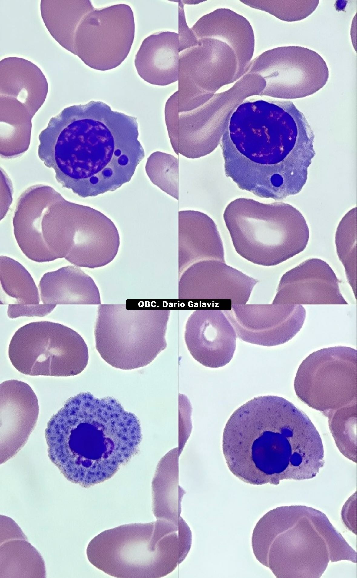 ANEMIA EN ESTUDIO