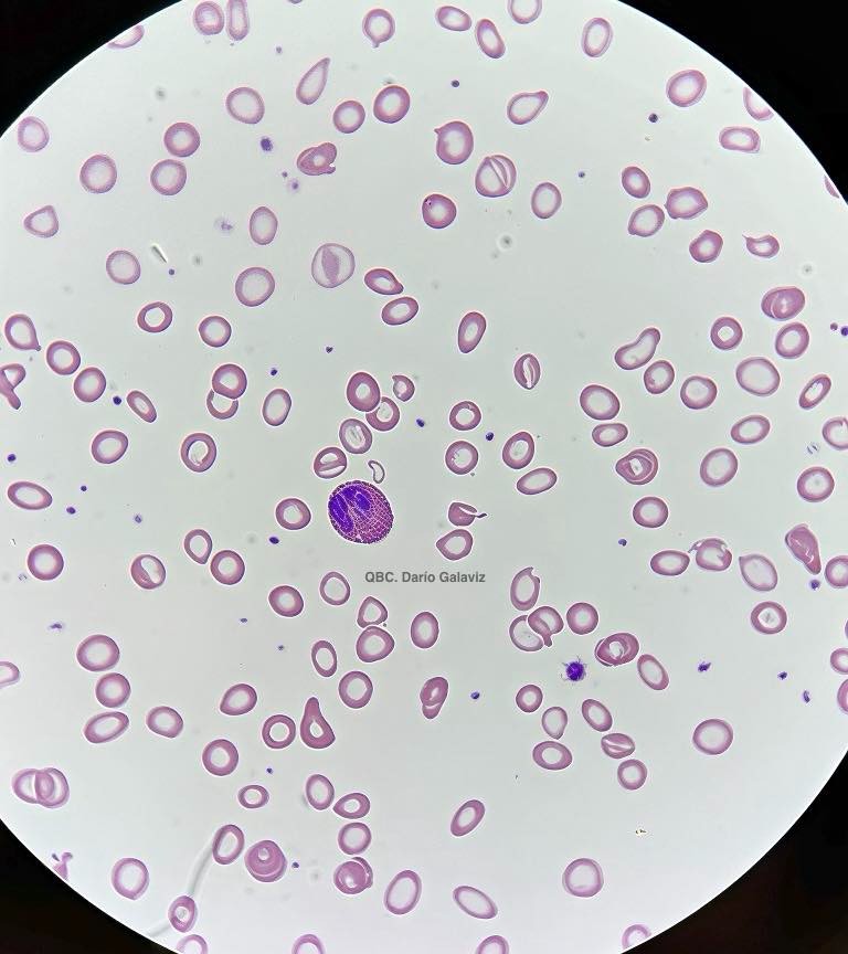 SINDROME ANÉMICO