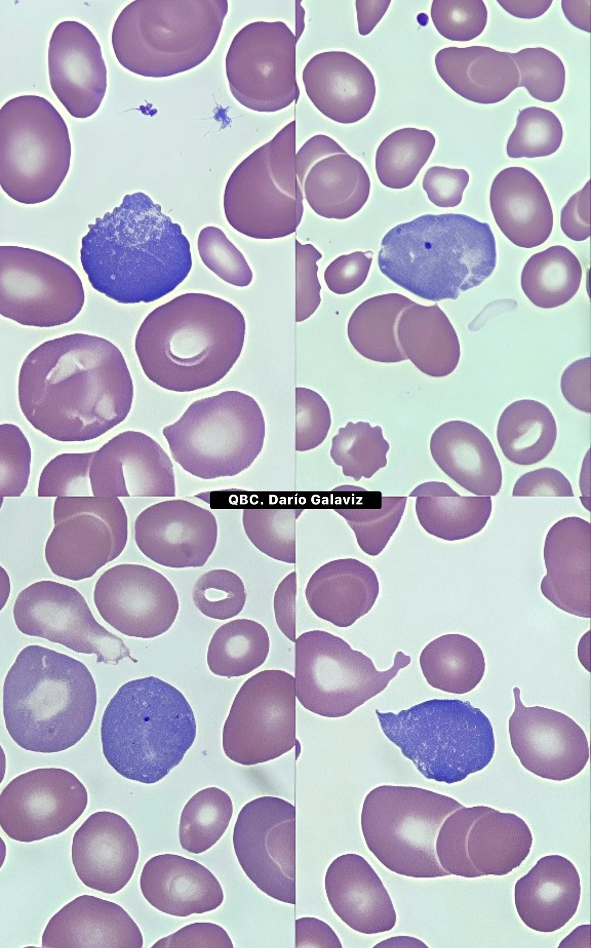 ANEMIA MEGALOBLÁSTICA