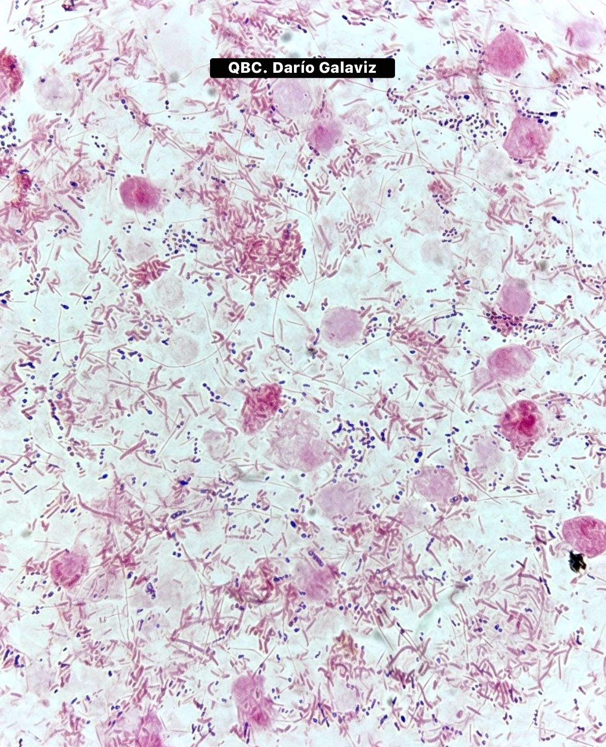 EMPIEMA PULMONAR