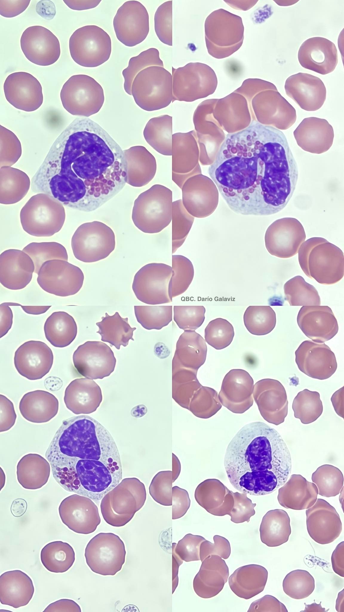 EOSINÓFILOS DISPLÁSICOS