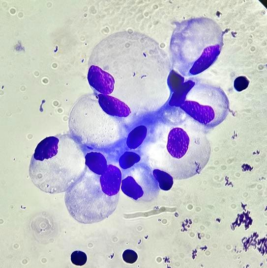 DERRAME PLEURAL