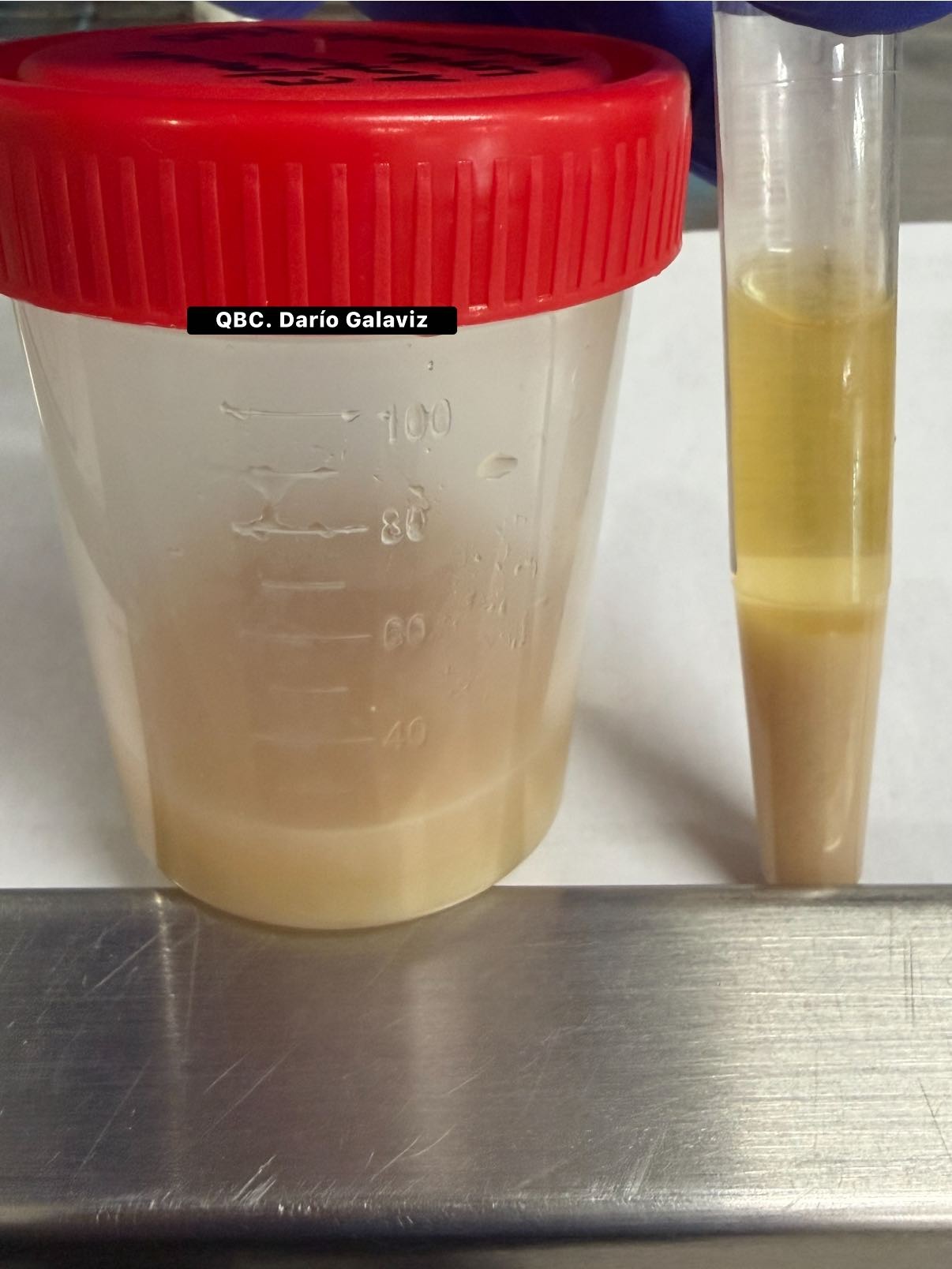 INFECCIÓN EN VÍAS URINARIAS