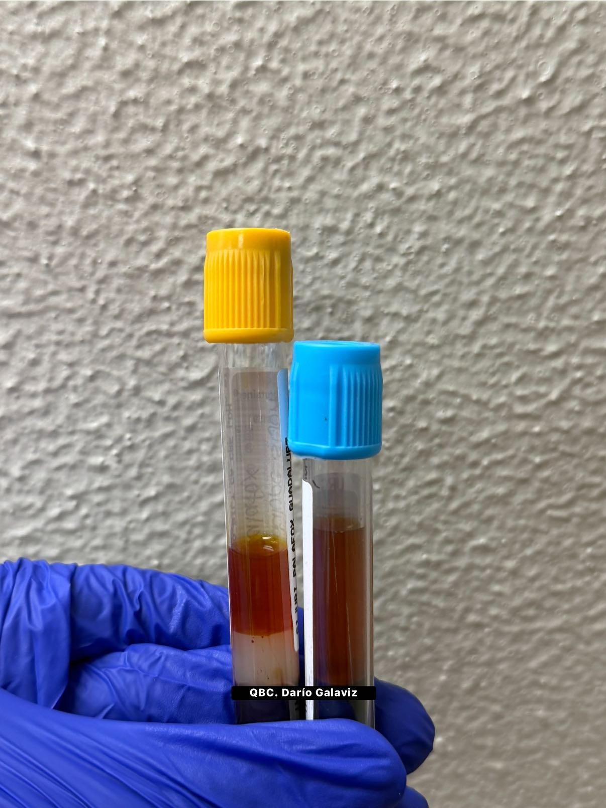 HEPATOCARCINOMA