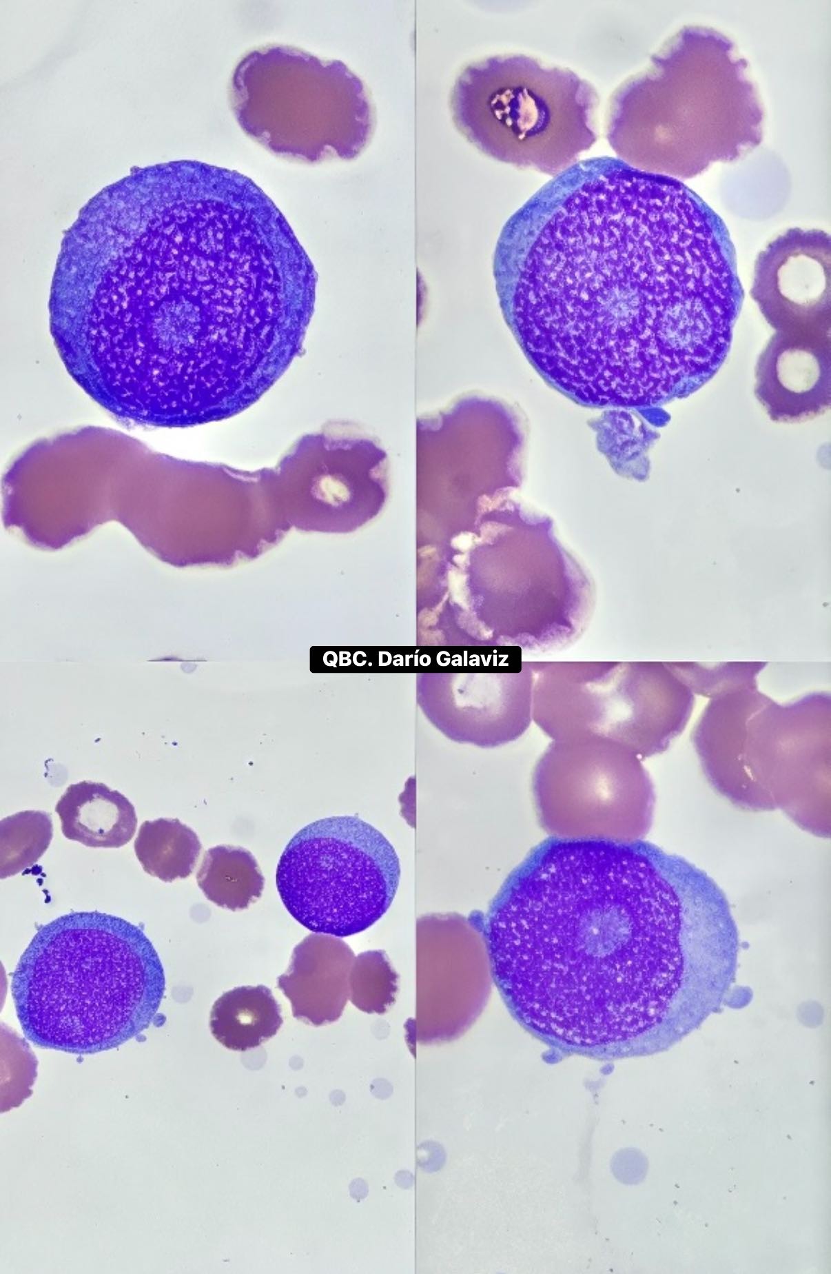 PROBABLE LEUCEMIA