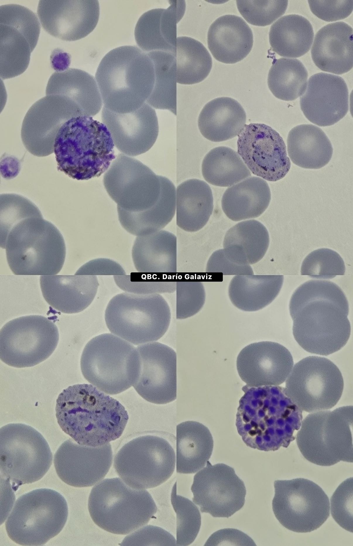Plasmodium vivax