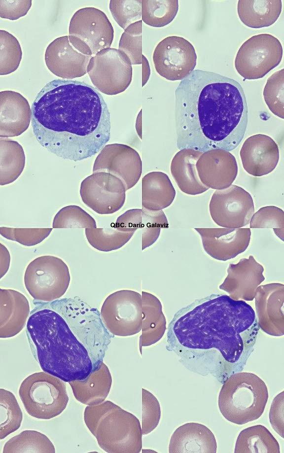 LUPUS