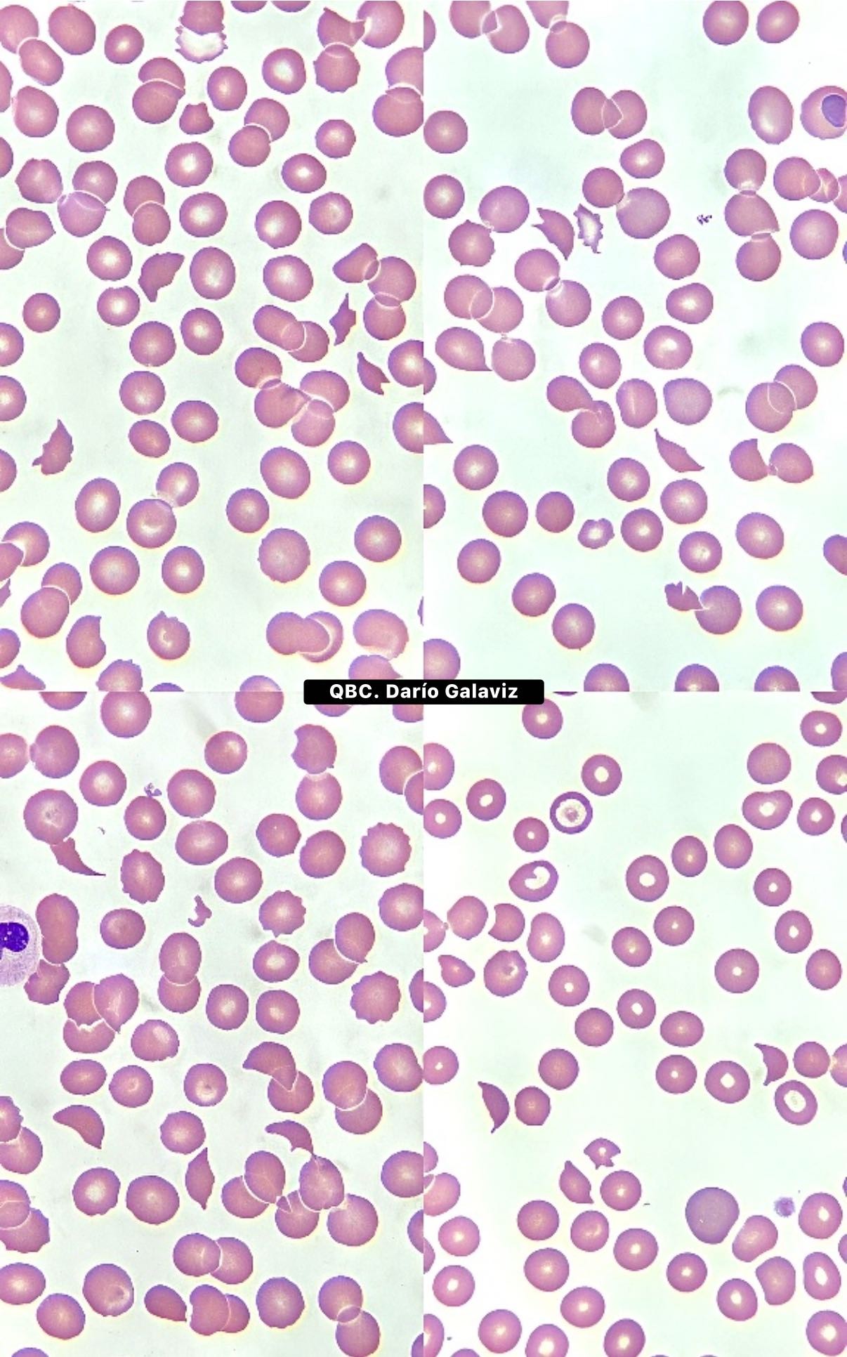 PREECLAMPSIA