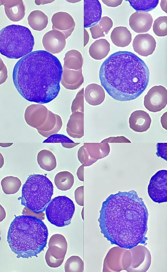 LEUCEMIA LINFOBLÁSTICA AGUDA