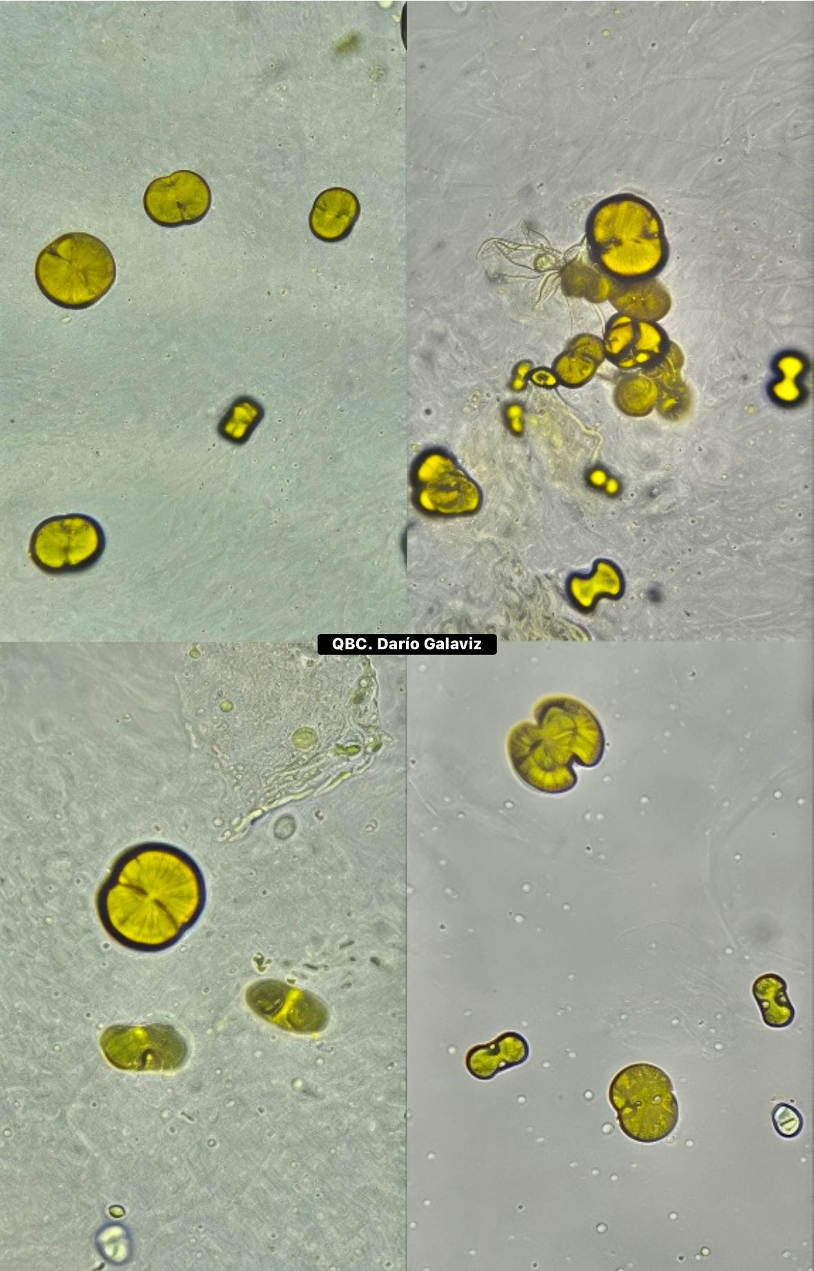 COLELITIASIS