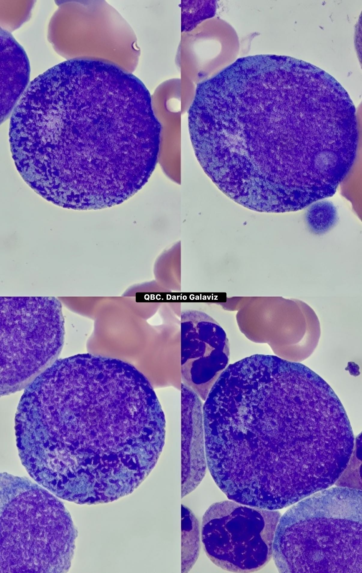 LEUCEMIA MIELOIDE CRÓNICA