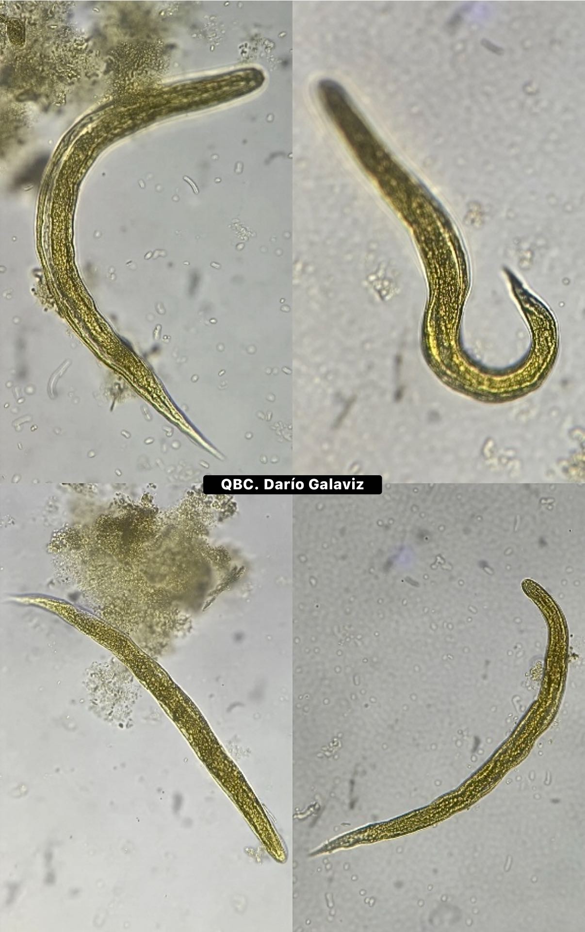 Strongyloides stercoralis