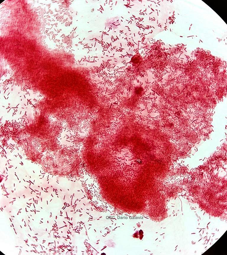 MENINGITIS