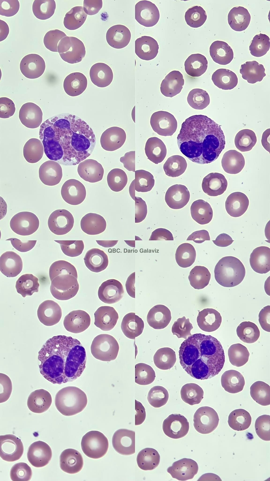 EOSINOFILIA EN ERC