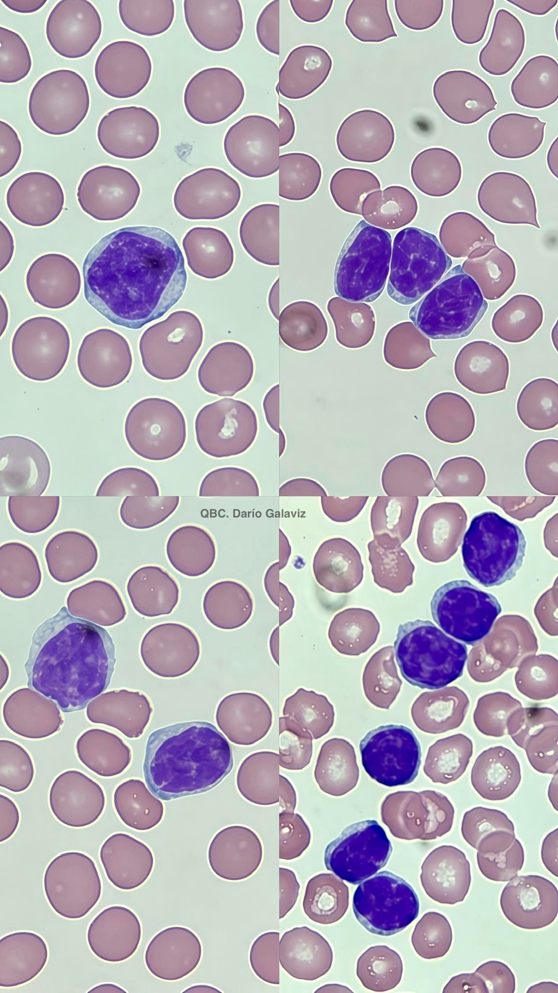 LEUCEMIA LINFOCÍTICA CRÓNICA