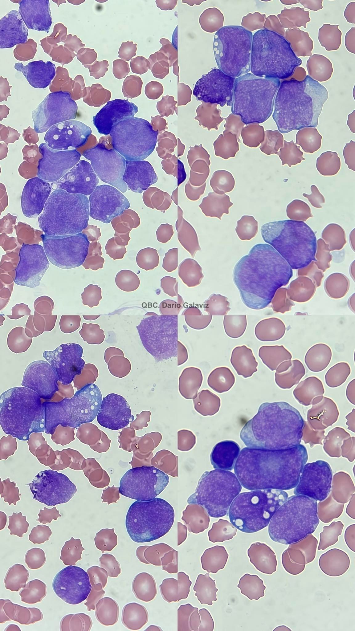 LEUCEMIA